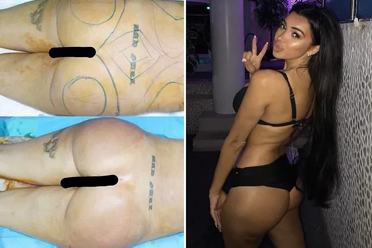 Chloe Khan posts dramatic before-and-after shots of Brazilian Bum Lift transformation