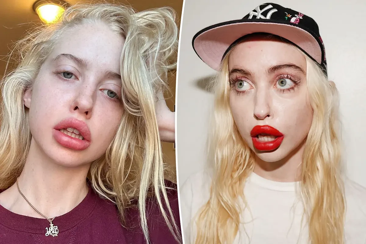 ‘Euphoria’ star Chloe Cherry says she’s gotten so much lip filler, she doesn’t need numbing cream anymore